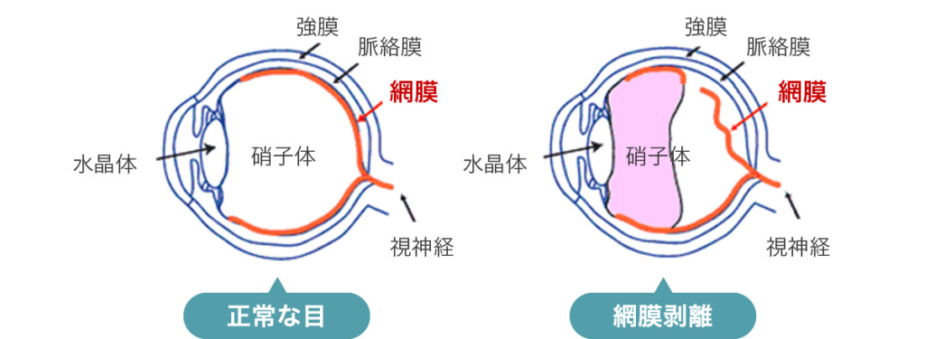 網膜剥離 | 出田眼科病院｜熊本県の眼科専門病院